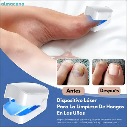 Laser Para Hongo En Las Uñas